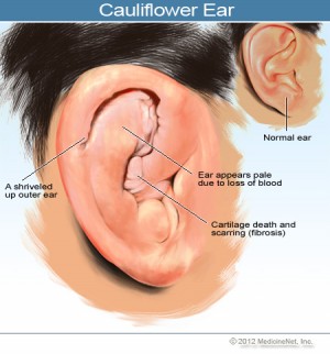 2012-cauliflower-ear-2